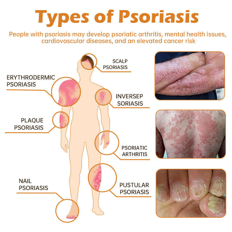 Jaunzēlandes bišu indes psoriāzes ārstēšanas krēms (piemērots visiem ādas stāvokļiem)