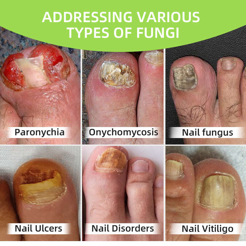 Dispositivo de terapia a laser para fungos nas unhas Furzero™ Max Plus