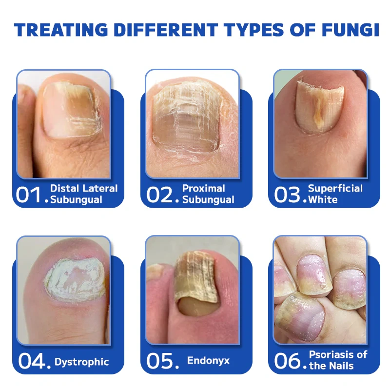 Dispositivo de tratamento a laser para fungos nas unhas Furzero™