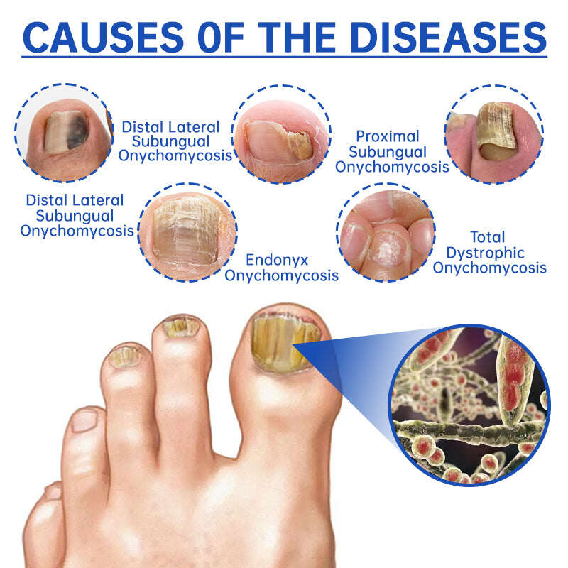 Dispositivo de tratamento de fungos a laser Furzero™ PureNail