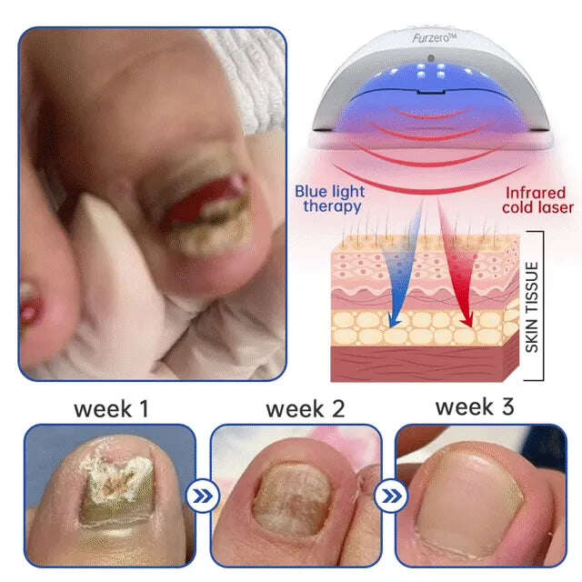 DISPOZITIV DE TRATARE LASER FUNGICI FURZERO™ PURENAIL