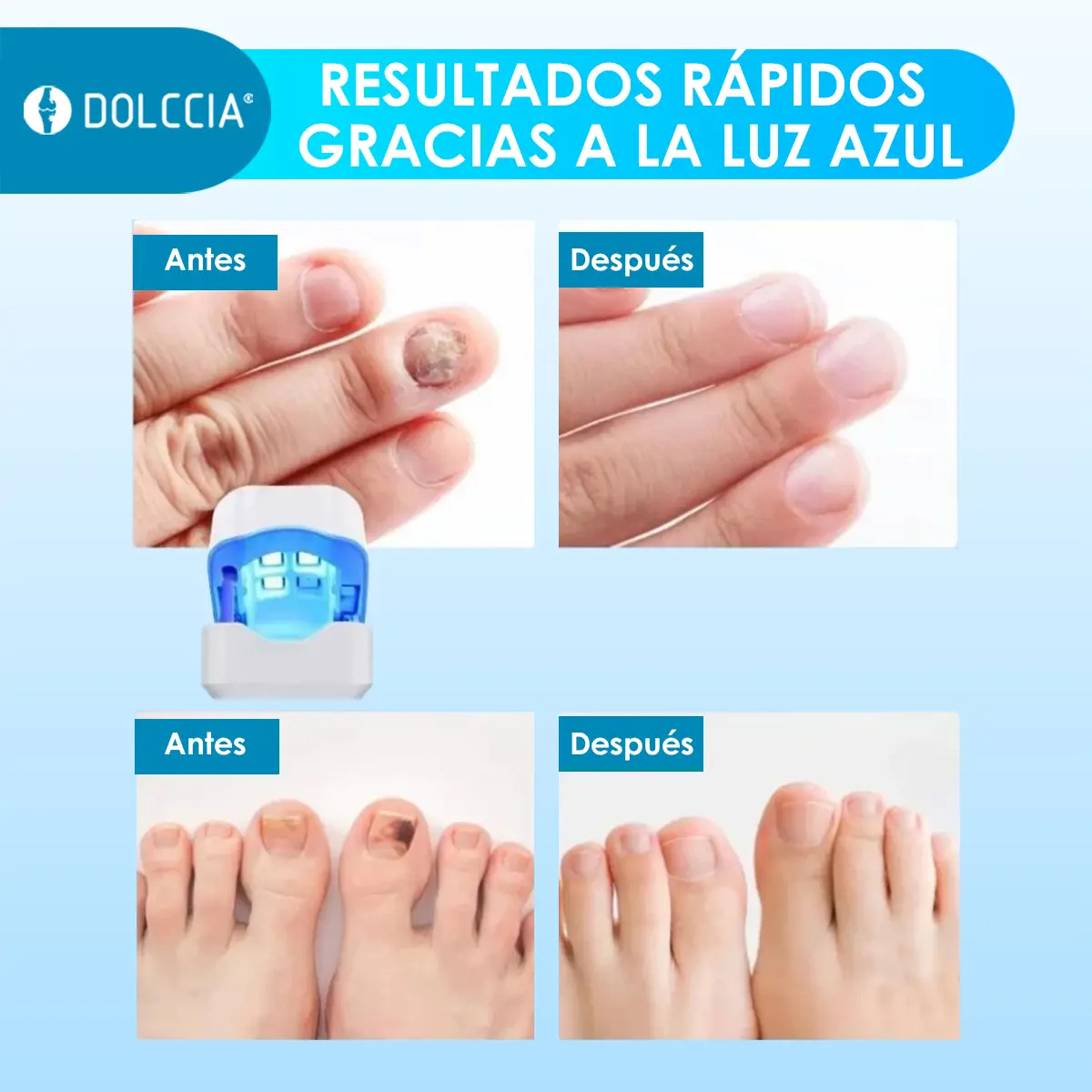 LASER DE UNHAS DO PÉ DOLCBIA®