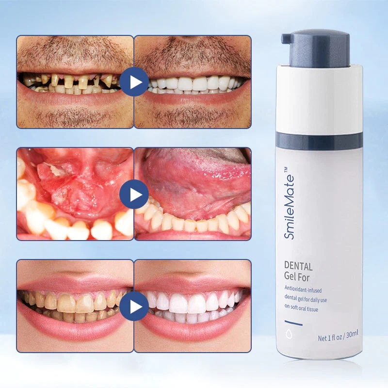 Gel restaurador refrescante e branqueador de dentes SmileMate