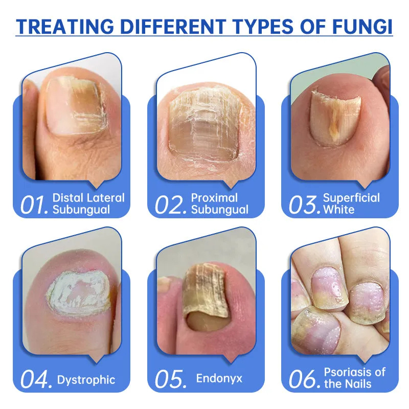 DISPOSITIVO DE TRATAMENTO A LASER FURZERO™ PURENAILU