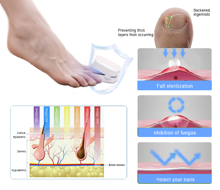 Fivfivgo™ Um dispositivo de fototerapia revolucionário e altamente eficaz para doenças das unhas dos pés