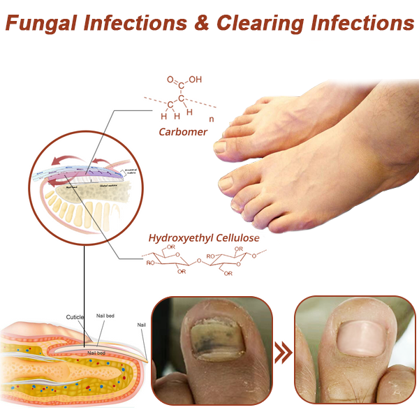 Fivfivgo™ Um dispositivo de fototerapia revolucionário e altamente eficaz para doenças das unhas dos pés