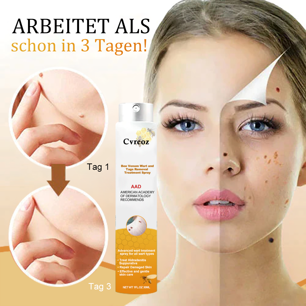 [🧡Magazin oficial al mărcii🧡]🥇Spray de tratament pentru îndepărtarea negilor și a etichetelor cu venin de albine Cvreoz (👨‍⚕AAD RECOMANDAT)🐝🐝(🔥Promoție de ultima zi 80% reducere)