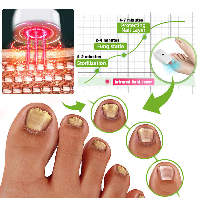 Dispositivo de tratamento a laser para fungos nas unhas 