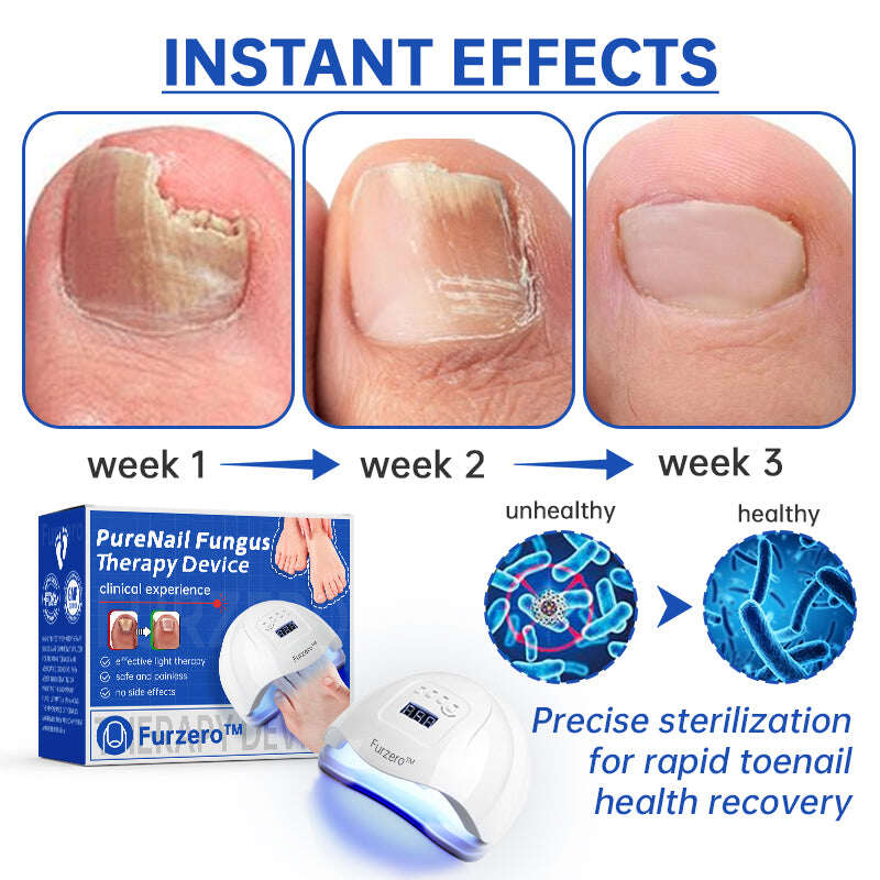 Dispositivo de tratamento de fungos a laser Furzero™ PureNail