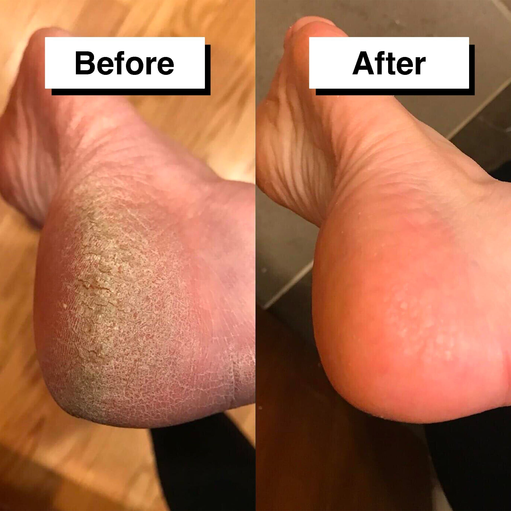 PedicuureTM: Automatikus bőrkeményedés eltávolító