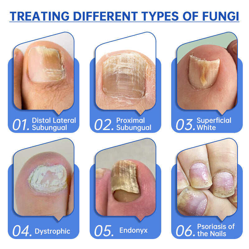 Dispositivo per il trattamento laser dei funghi Furzero™ PureNail