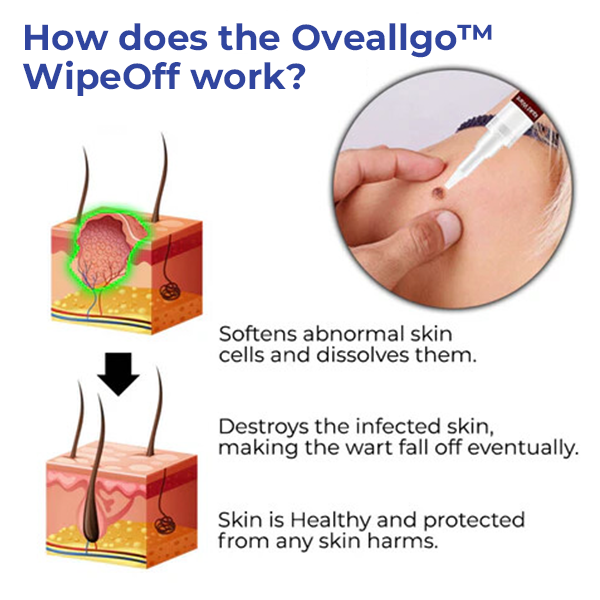 ✅Oficiální obchod: Oveallgo™ WipeOff Tags & Moles Remover 👨‍⚕️ Schváleno American Academy of Dermatology Association (AAD)