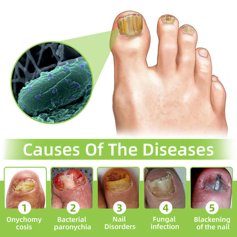 Dispositivo de terapia a laser para fungos nas unhas Furzero™ Max Plus