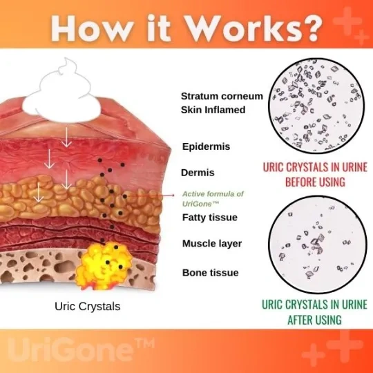 UriGone™ Pomada para a gota