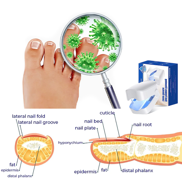 Fivfivgo™ Um dispositivo de fototerapia revolucionário e altamente eficaz para doenças das unhas dos pés