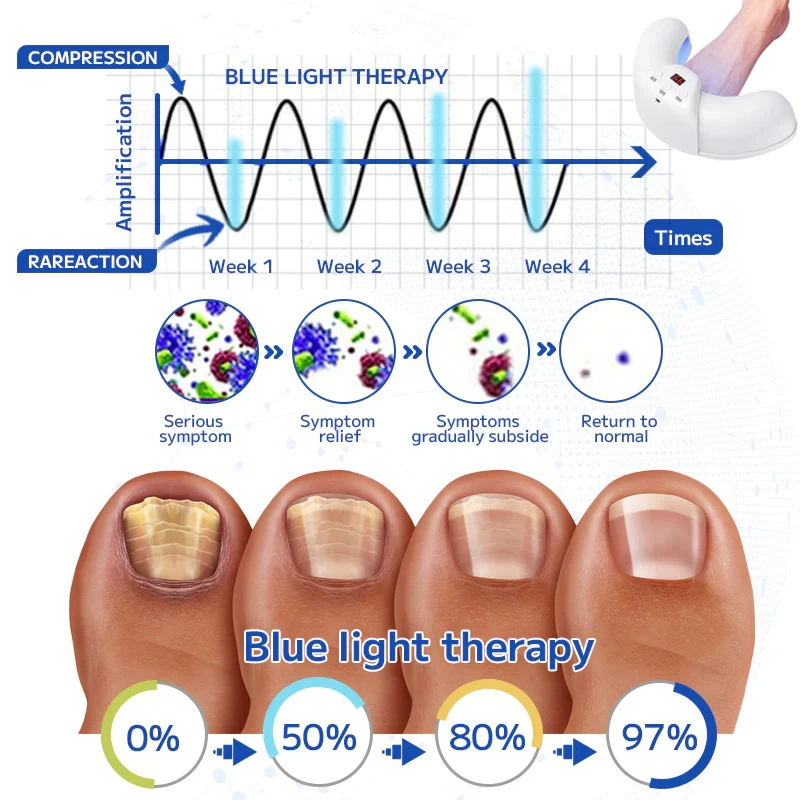 Dispositivo de tratamento a laser para fungos nas unhas Furzero™