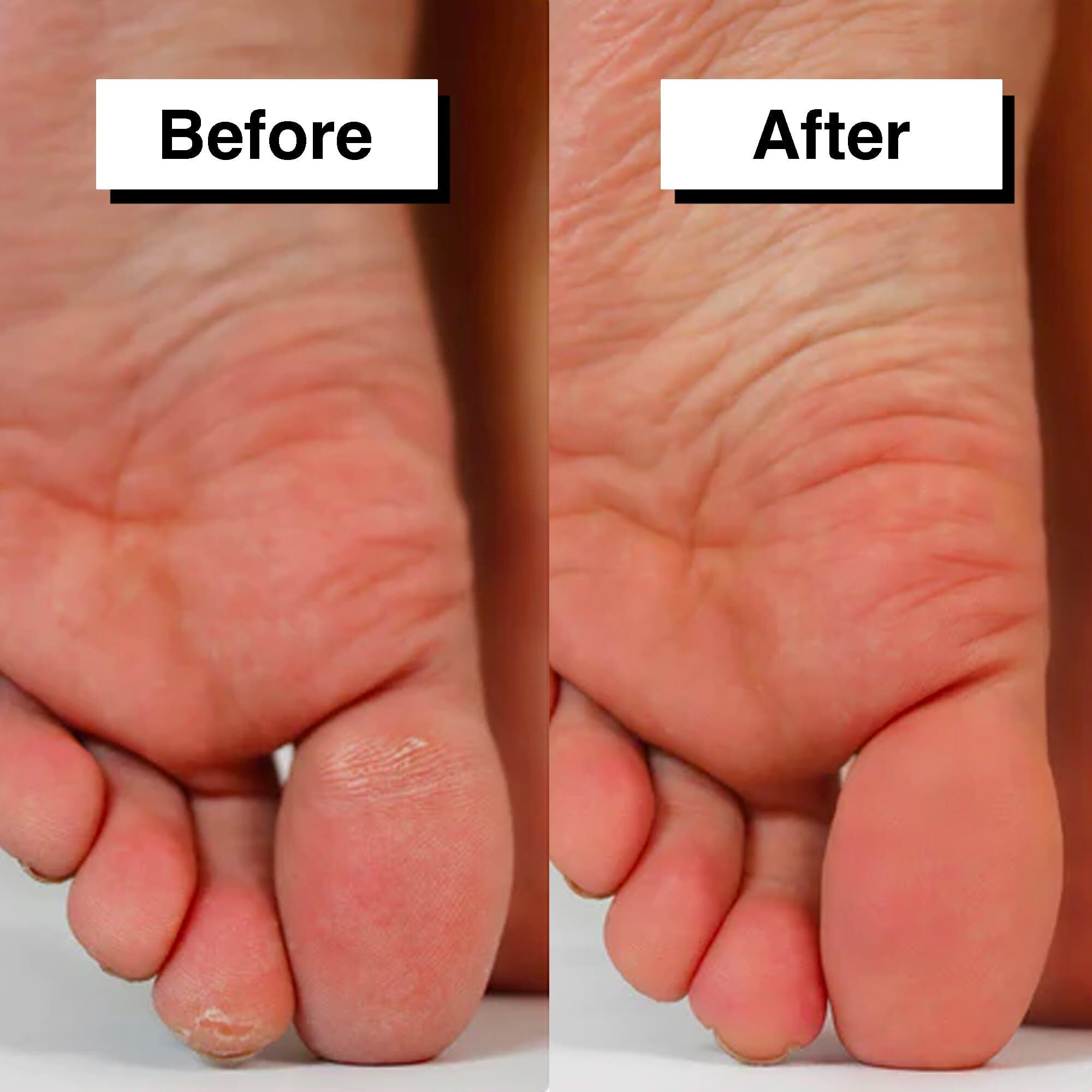 PedicuureTM: Automatikus bőrkeményedés eltávolító