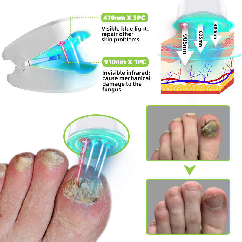 Dispositivo de tratamento a laser para fungos nas unhas 