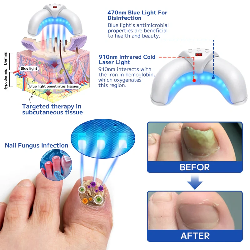 Dispositivo de tratamento a laser para fungos nas unhas Furzero™