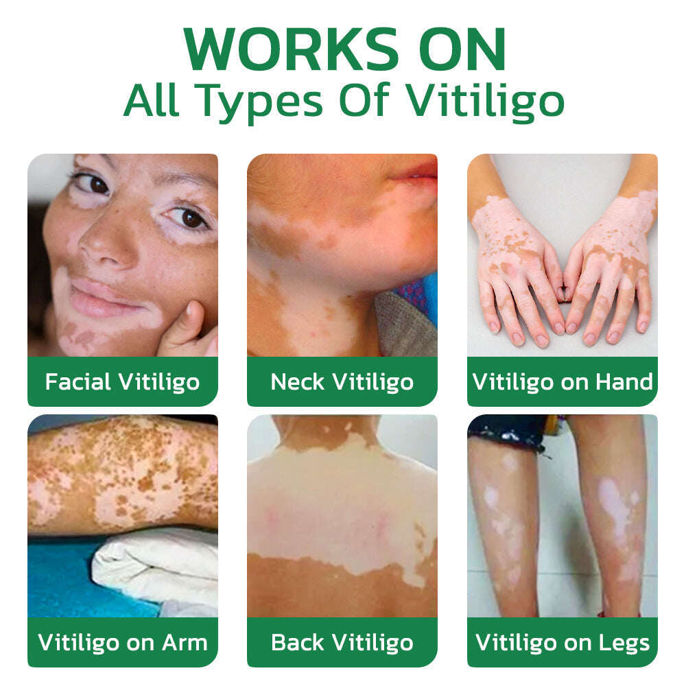 GFOUK™ TreatVitiligo rahustav kreem