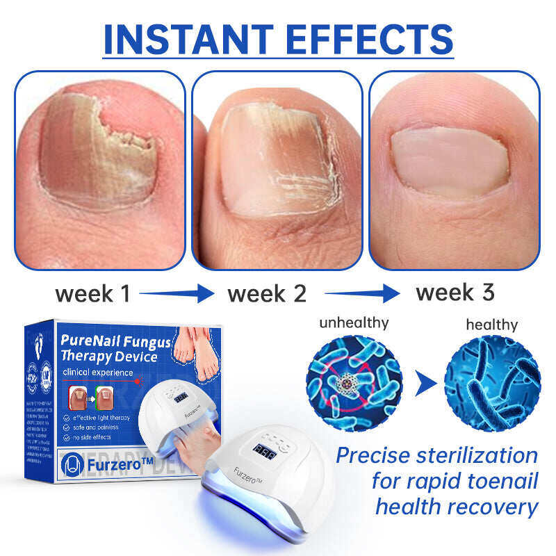 Dispositivo per il trattamento laser dei funghi Furzero™ PureNail