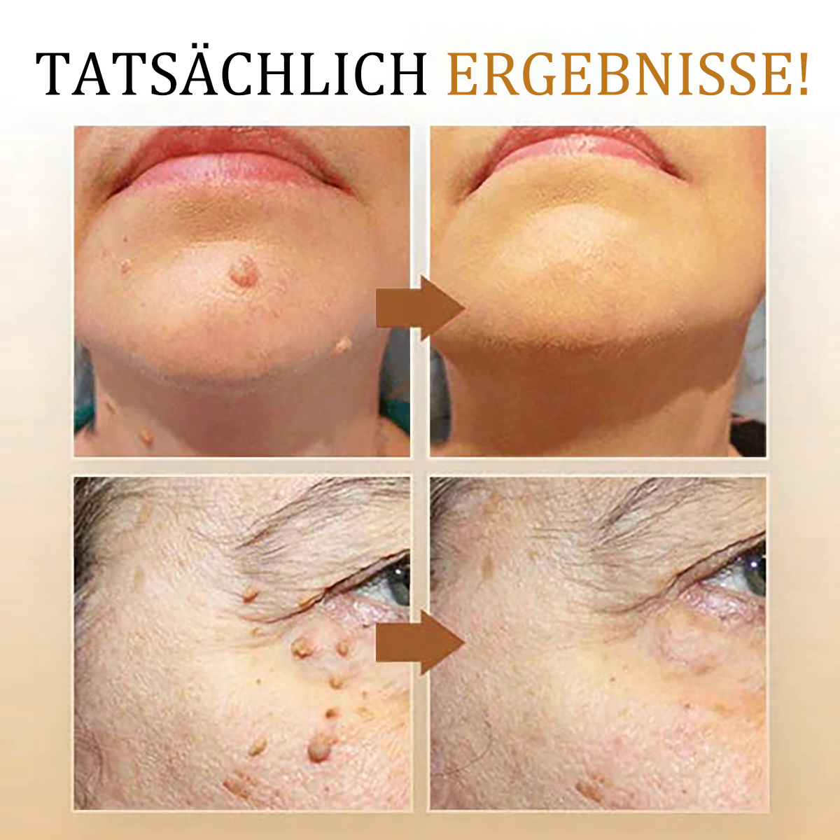 [🧡Magazin oficial al mărcii🧡]🥇Spray de tratament pentru îndepărtarea negilor și a etichetelor cu venin de albine Cvreoz (👨‍⚕AAD RECOMANDAT)🐝🐝(🔥Promoție de ultima zi 80% reducere)